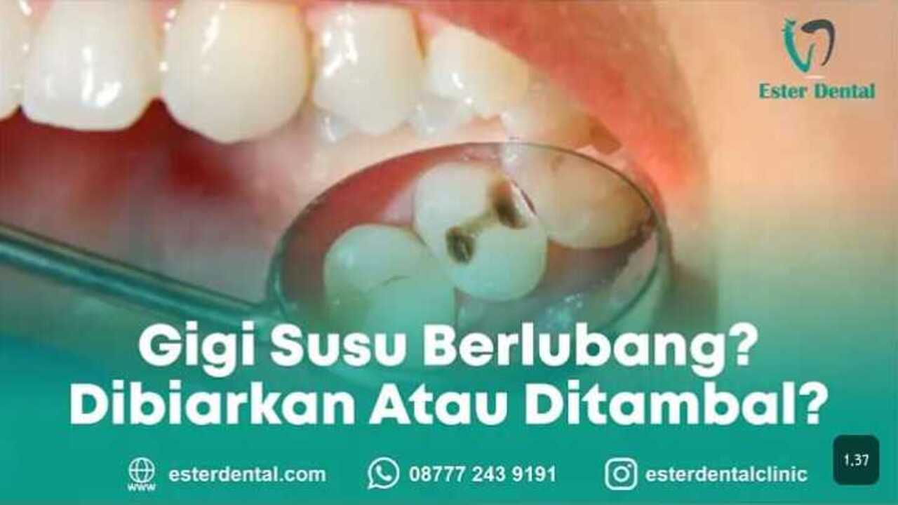 Gigi Susu Berlubang, Gimana Sih Sebaiknya? Yuk Cari Tahu!