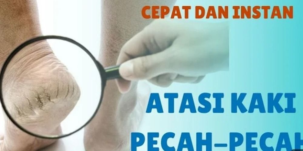 Cara Alami Menghilangkan Tumit Pecah-Pecah dengan Bahan Seadanya di Rumah