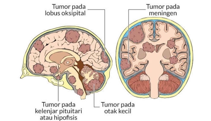 Mengenali Gejala Kanker Otak: Pentingnya Deteksi Dini