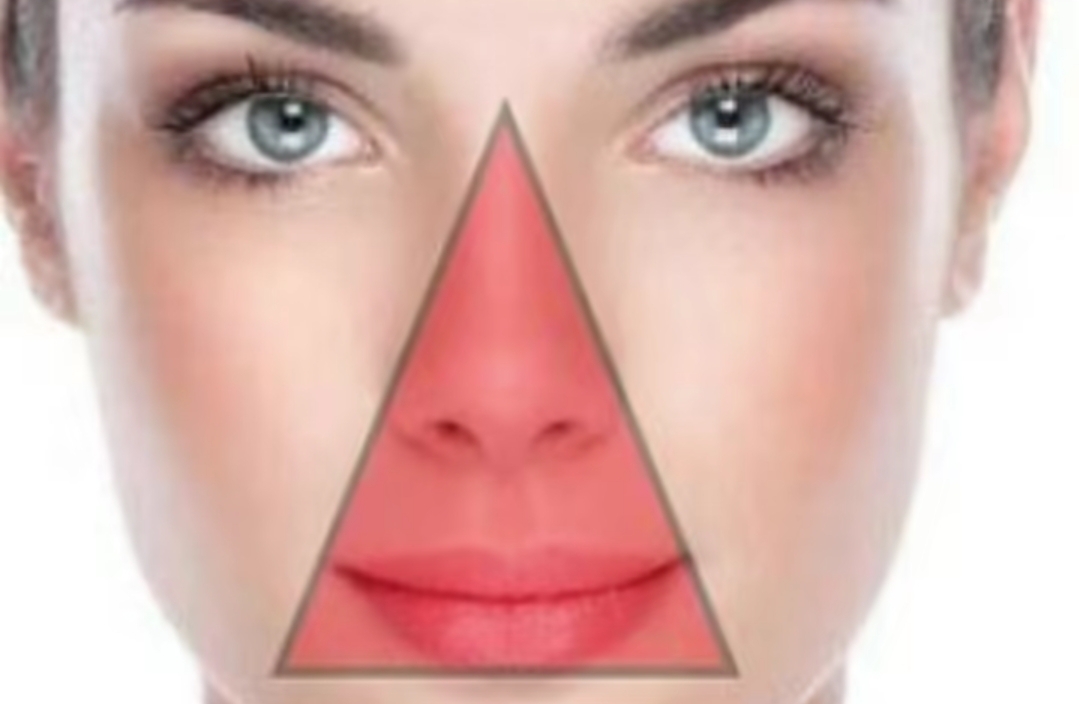 Memencet Jerawat Bisa Berakibat Fatal? Kenali Segitiga Berbahaya di Wajah