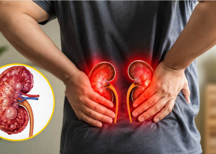 8 Kebiasaan Sepele yang Diam-Diam Bisa Memicu Gagal Ginjal, Nomor 5 Masih Dilakukan Banyak Orang