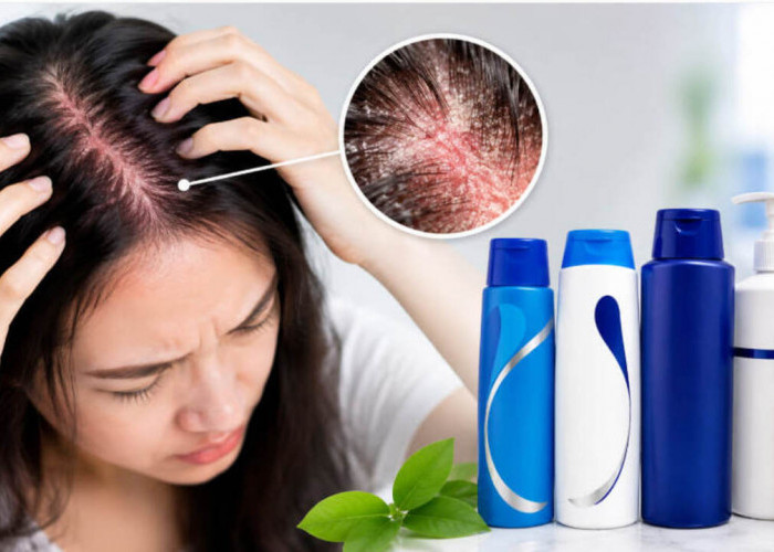 Ketombe Tak Kunjung Hilang? Ini 10 Shampo Terbaik untuk Dermatitis Seboroik Ampuh Redakan Ketombe Membandel