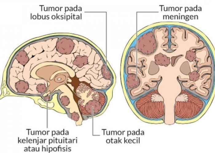 Mengenali Gejala Kanker Otak: Pentingnya Deteksi Dini
