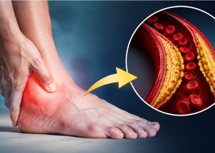 Jangan Sepelekan Kaki! 7 Tanda Kolesterol Tinggi yang Bisa Muncul Tanpa Disadari
