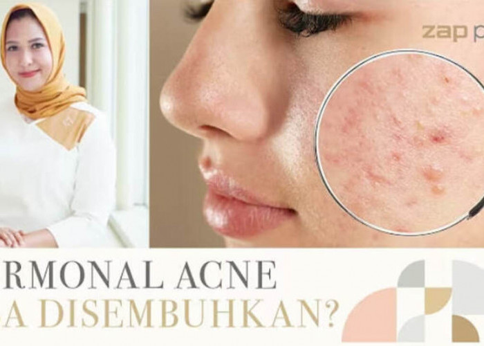 Jerawat Tak Kunjung Hilang? Bisa Jadi Bukan Skincare, Tapi Hormon dan Stres!