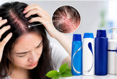 Ketombe Tak Kunjung Hilang? Ini 10 Shampo Terbaik untuk Dermatitis Seboroik Ampuh Redakan Ketombe Membandel