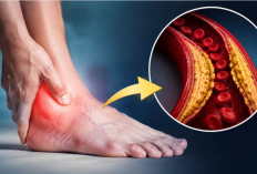 Jangan Sepelekan Kaki! 7 Tanda Kolesterol Tinggi yang Bisa Muncul Tanpa Disadari