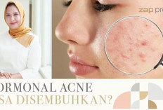 Jerawat Tak Kunjung Hilang? Bisa Jadi Bukan Skincare, Tapi Hormon dan Stres!