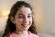 Jangan Panik! Begini Tips Mengatasi Jerawat pada Anak Usia 9–12 Tahun